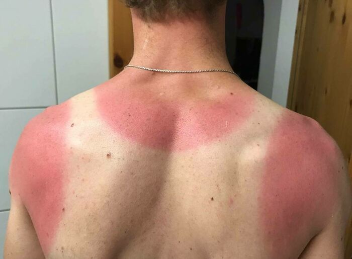 Forgot Sunscreen