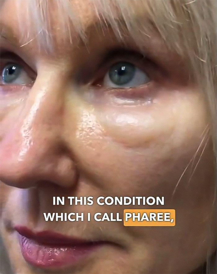 &ldquo;Never Getting Fillers&rdquo;: After MRI Of Woman Stuns Viewers, Doctor Discusses Effects