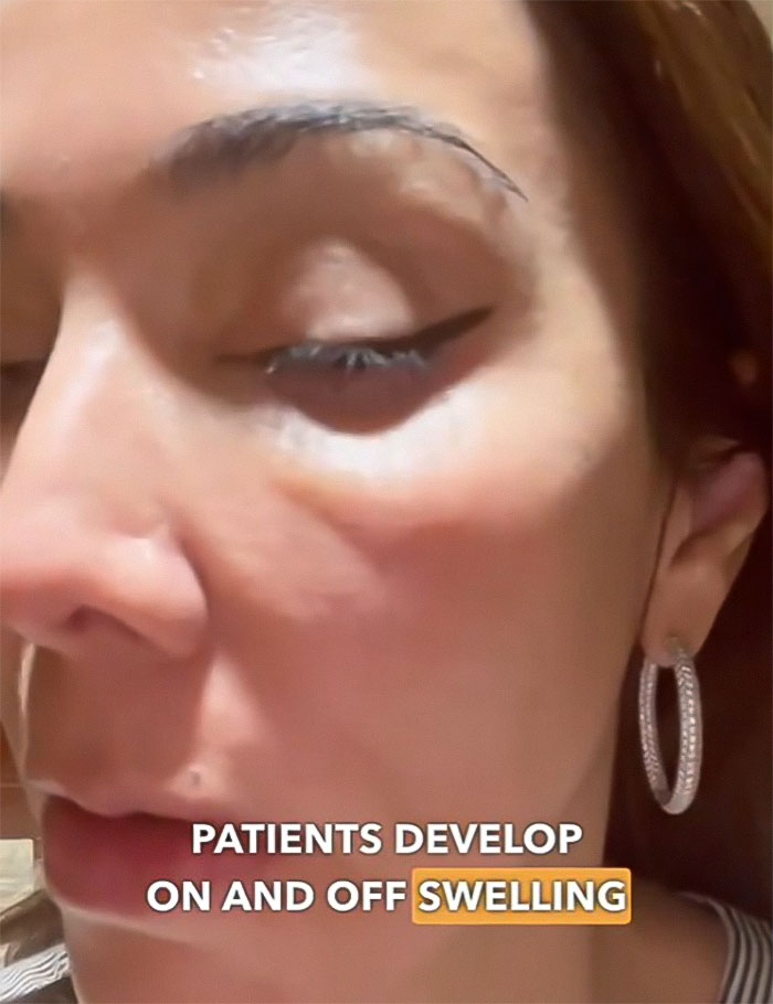 &ldquo;Never Getting Fillers&rdquo;: After MRI Of Woman Stuns Viewers, Doctor Discusses Effects