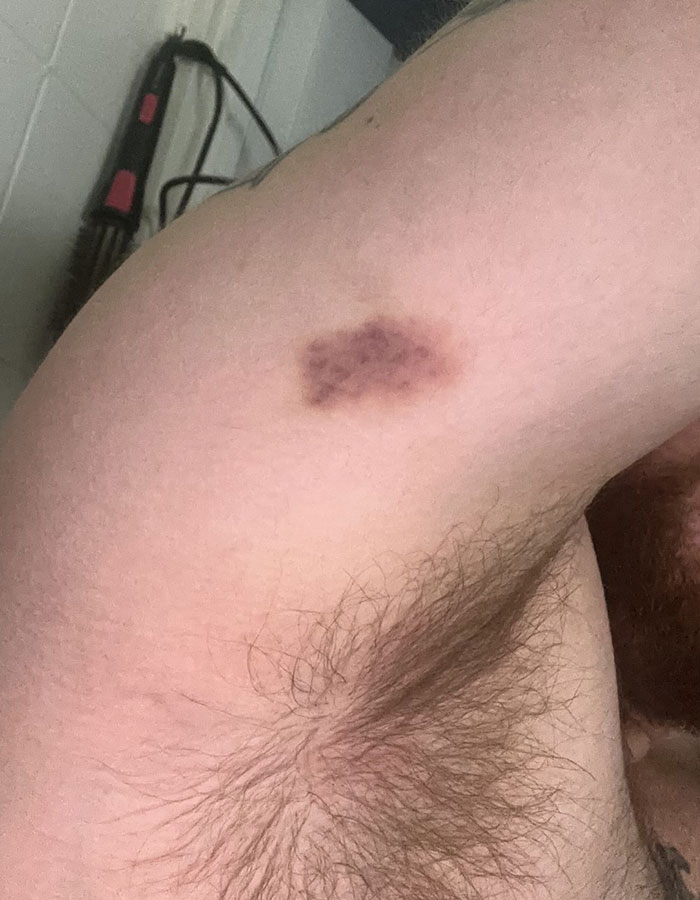 29-Year-Old Trans Man Gets Brutally Beaten Up In Switzerland, Claims It&rsquo;s A Hate Crime