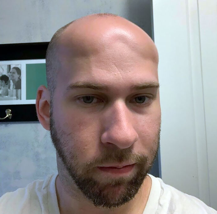 My Husband Got Scalp Edema From A Severe Sunburn