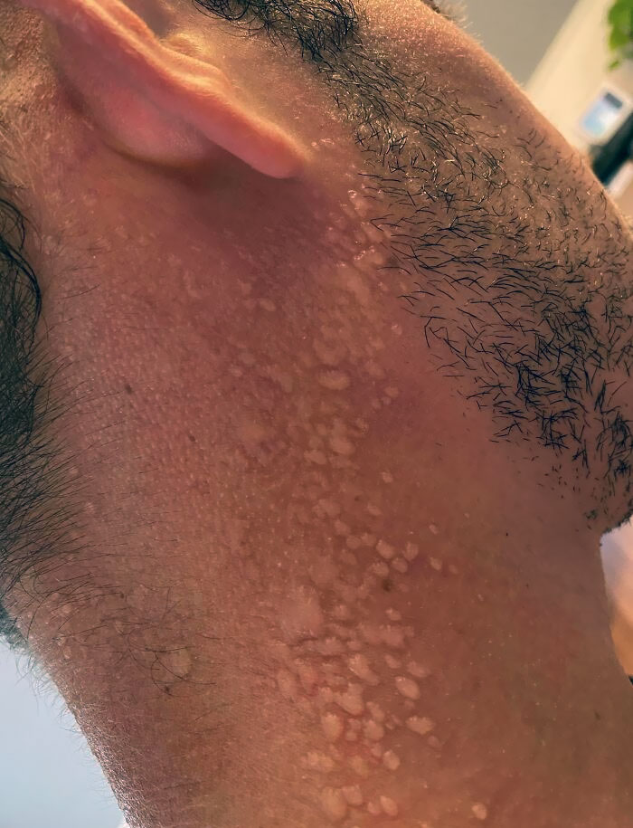 My Sunburn From A Few Days Ago Started To Peel. I Went For A Run Today And All The Sweat Got Caught Underneath The Dead Skin And Formed A Lot Of Sweat Bubbles