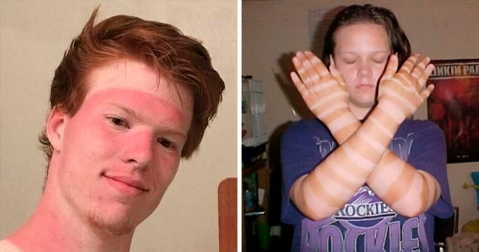 50 Times People Posted Their Embarrassing Sunbathing Fails So You Can Learn From Their Mistakes