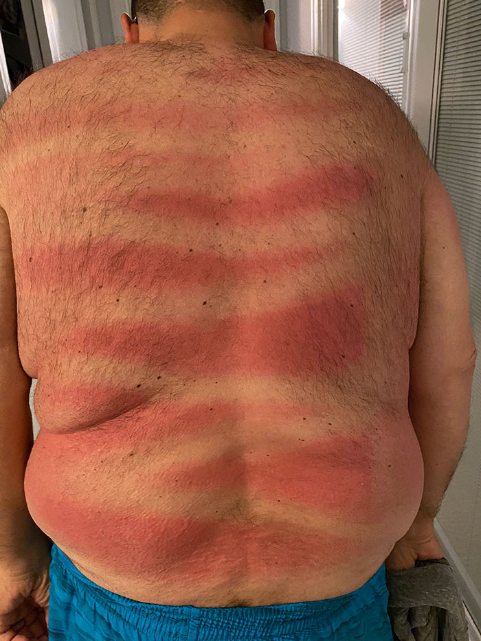 First Day At The Beach And My Wife Made Sure I Was Protected From Sunburn By Spraying My Back With Sunscreen. I Can’t See Back There - Did She Do A Good Job?