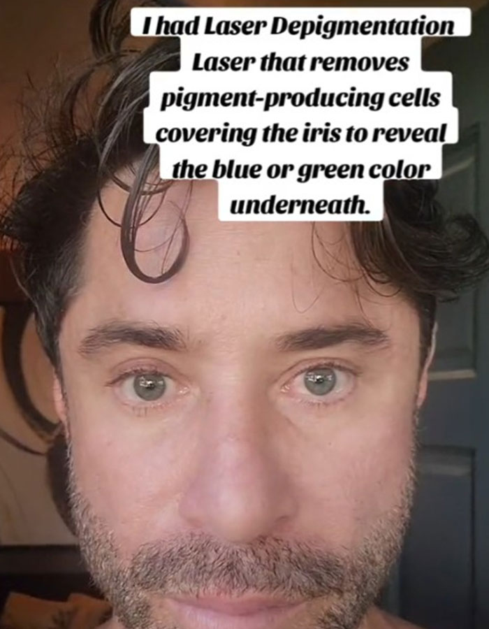 Patients Increasingly Changing Eye Color With Surgery Despite Over 90% Complication Rate