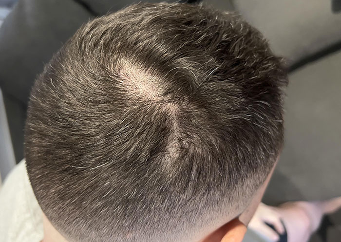 Went To A New Barber Yesterday. Was Given A Bald Spot