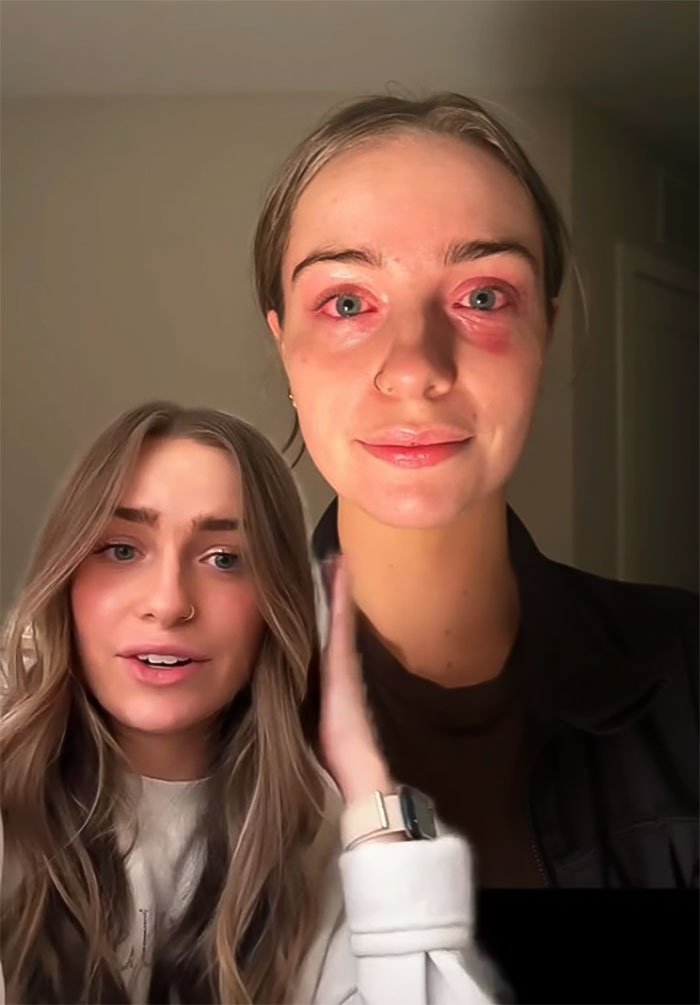 Woman Realizes She&rsquo;s Been &ldquo;Accidentally Poisoning&rdquo; Herself For Months After Removing Earrings