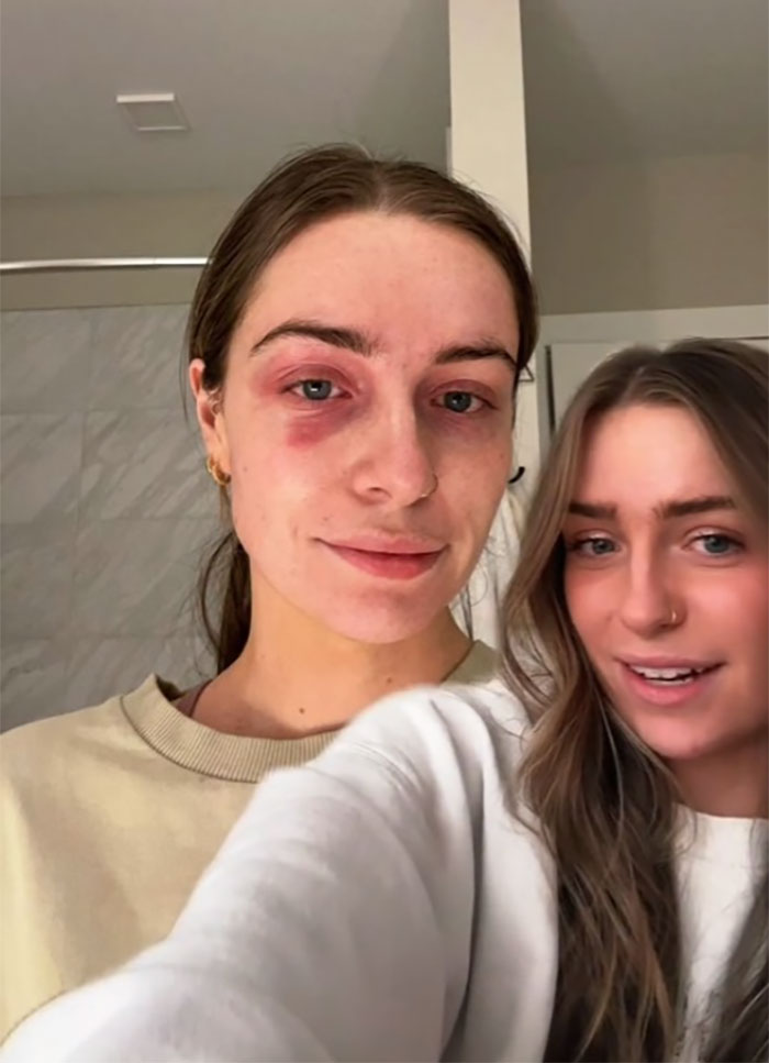 Woman Realizes She&rsquo;s Been &ldquo;Accidentally Poisoning&rdquo; Herself For Months After Removing Earrings