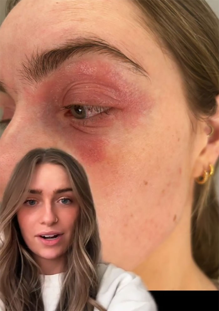 Woman Realizes She&rsquo;s Been &ldquo;Accidentally Poisoning&rdquo; Herself For Months After Removing Earrings