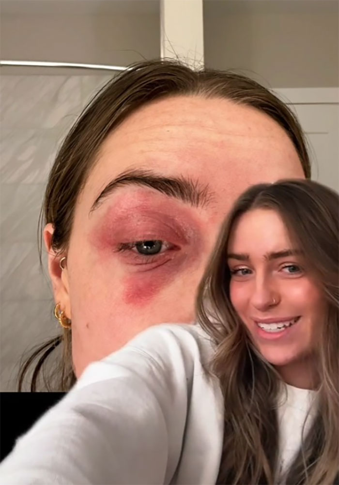 Woman Realizes She&rsquo;s Been &ldquo;Accidentally Poisoning&rdquo; Herself For Months After Removing Earrings