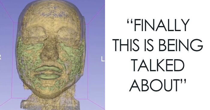 MRI Of 33-Year-Old Woman’s Face Reveals Where All Her Filler Went