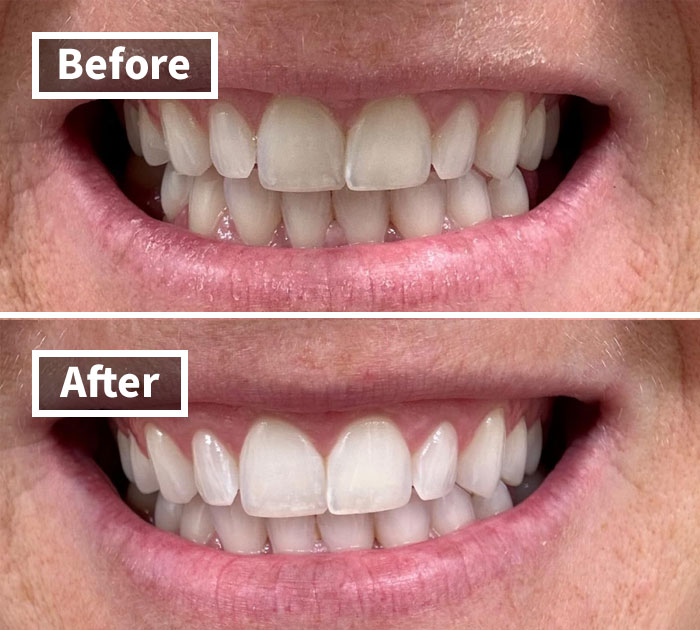 Crest 3D Whitestrips Professional Effects: Reveal Your Brightest Smile This Prime Day!