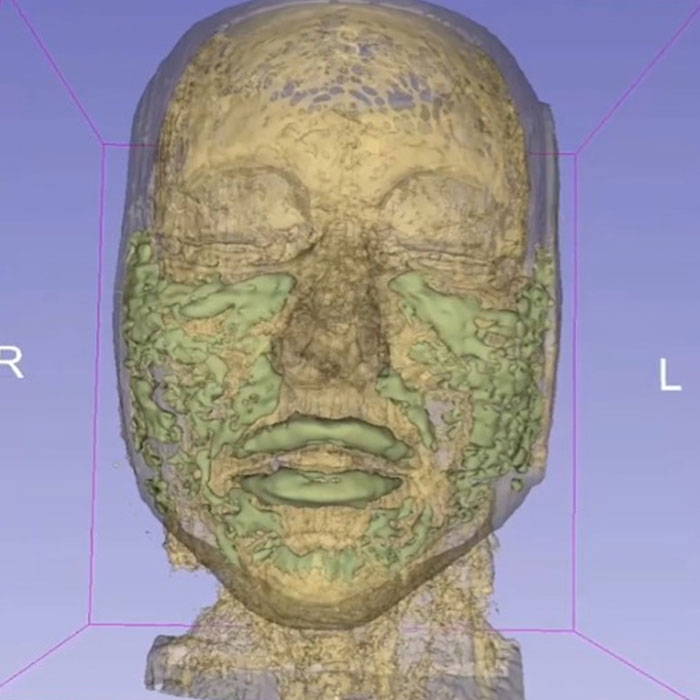 MRI Of 33-Year-Old Woman&rsquo;s Face Reveals Where All Her Filler Went