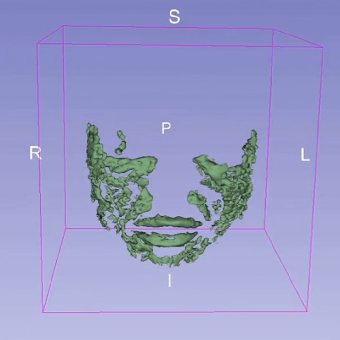 MRI Of 33-Year-Old Woman&rsquo;s Face Reveals Where All Her Filler Went