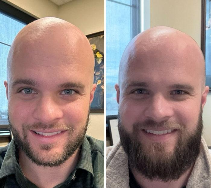 This Is My First Time Trying To Grow A Beard. Wondering If I Should Go Back To Short, Keep As Is, Or Keep Growing? 3 Months Of Growth