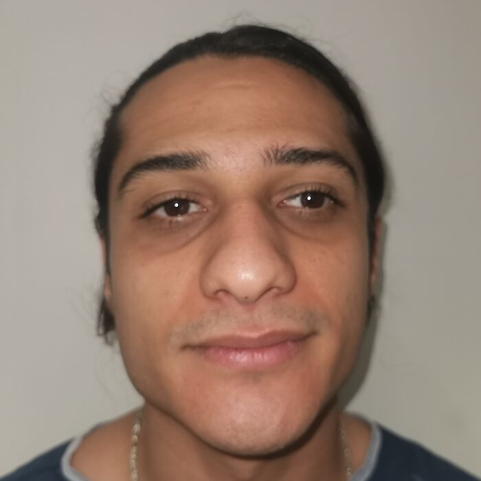 “He Needs A New Identity”: Man Looks Unrecognizable After Going To Turkish Plastic Surgery Clinic “He Needs A New Identity”: Man Looks Unrecognizable After Going To Turkish Plastic Surgery Clinic