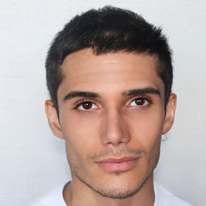 “He Needs A New Identity”: Man Looks Unrecognizable After Going To Turkish Plastic Surgery Clinic “He Needs A New Identity”: Man Looks Unrecognizable After Going To Turkish Plastic Surgery Clinic