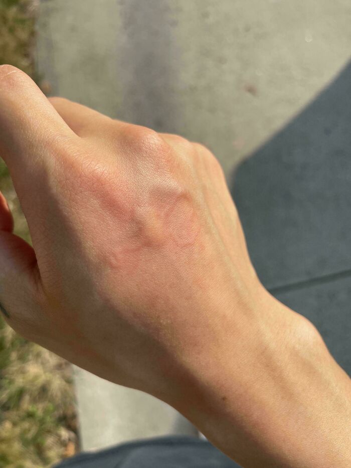 Weird Mosquito Bite