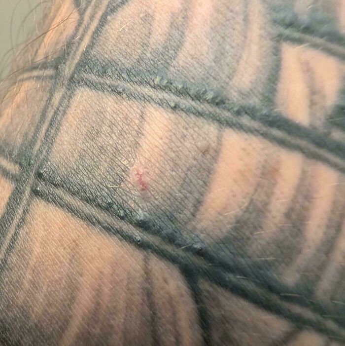 I'm Suddenly Forming Itchy Bumps Along Some Of The Lines Of My 7 Year Old Tattoo