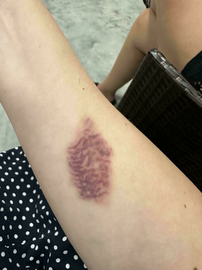 My Bruise Turned Into Squiggles