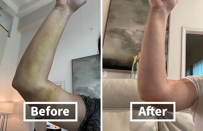 Before: Colorful Reminders Of That Epic Stumble (Or Clumsy Encounter With A Coffee Table) After: Arnica Bruise Relief Lotion Speeds Up The Healing Process, Fading Those Bruises Like A Bad Memory