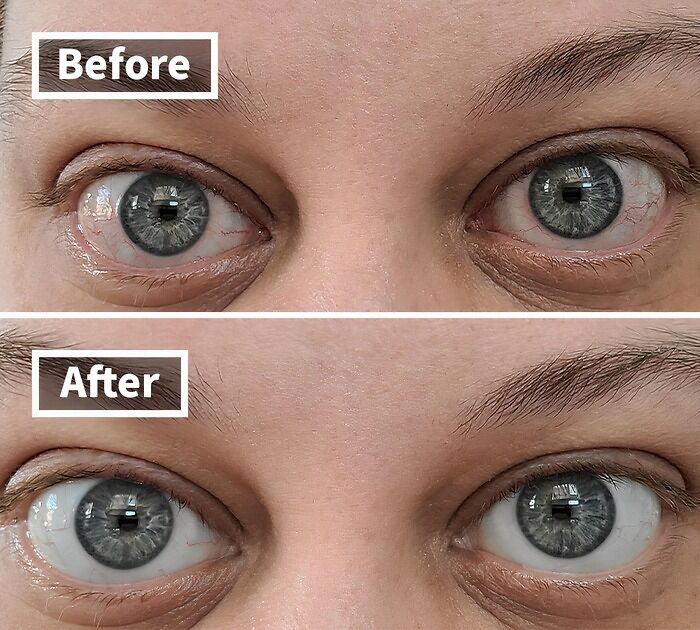 Before: Red, Irritated Eyes That Scream "I've Been Staring At A Screen All Day" (Or "I Had One Too Many Margaritas Last Night") After: Redness Reliever Eye Drops Work Their Magic, Bringing Back The Sparkle And Clarity To Your Peepers, So You Can Face The World With Confidence