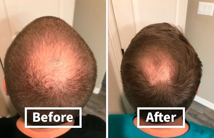 Before and after images of a man's head showing hair regrowth, highlighting love at first sight results.
