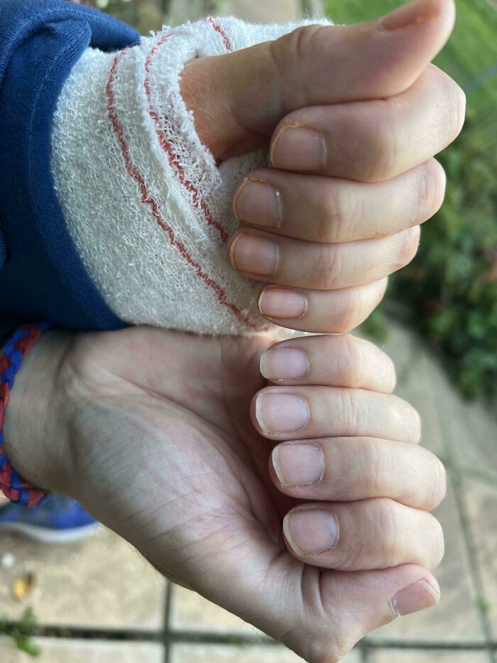 Broke My Arm - 1 Week Later Fingernails No Longer Grow At Same Rate