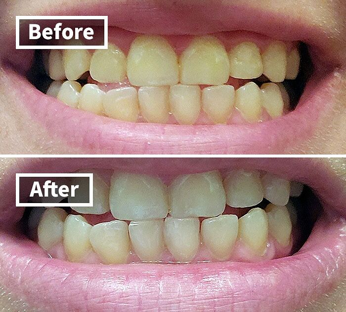 Before and after close-up of teeth showing improvement in color and whiteness from a beauty buy product use.