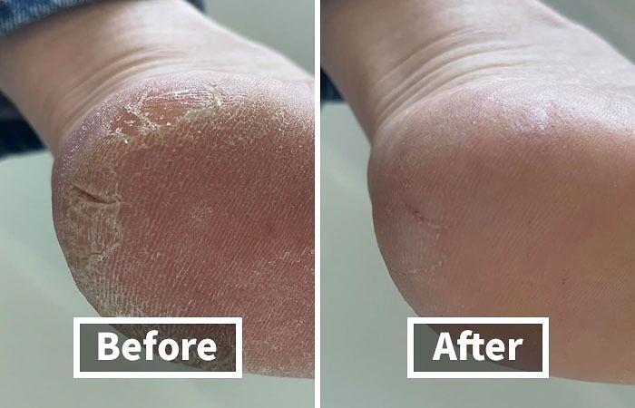 Close-up before and after photos showing dry c*****d heel transformed to smooth skin with beauty buys.