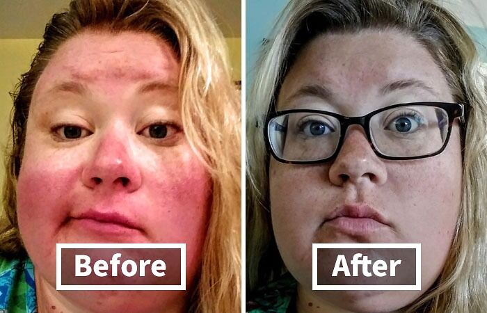 Before and after photos showing effects of a beauty buy improving skin redness and texture in a close-up portrait.