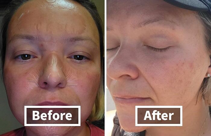 Pimple Emergency? mighty Patch To The Rescue! These Hydrocolloid Patches Will Shrink Those Blemishes Faster Than You Can Say "Selfie"