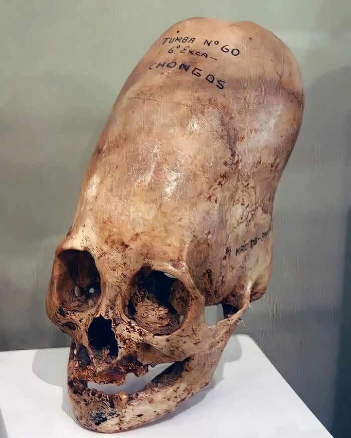 The Peruvian Archaeologist Discovered More Than 300 Mysterious Skulls Believed To Be At Least 3000 Years Old Antiquity. The Volume Of These Skulls Is About 25% Bigger Than Of The Average Human Skull And They May Weigh Up To 60% More