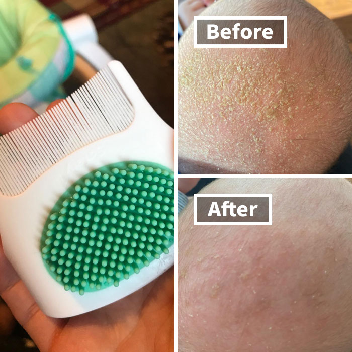 Baby's Got Cradle Cap? No Worries! This Gentle Brush And Comb Set Will Tackle Those Flakes Like A Pro, Leaving Your Little One's Scalp Feeling Soft And Soothed
