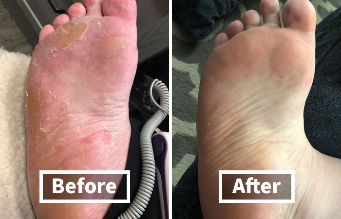 Don't Let Dry, Rough Feet Hold You Back From Living Your Best Life. A Foot Peel Mask Is The Key To Stepping Out With Confidence