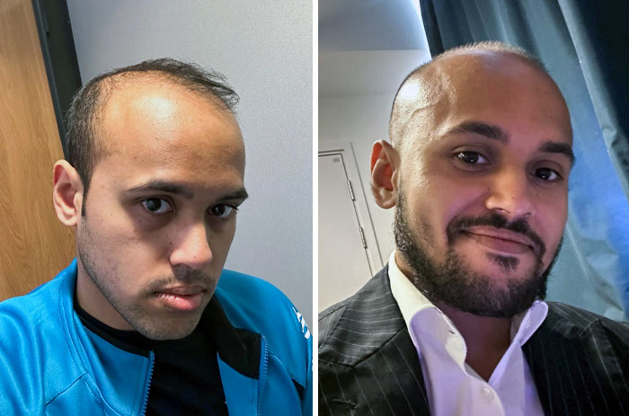 I Decided To Grow A Beard And Accepted The Bald Look