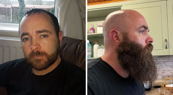 Receding Hair And Short Beard vs. Bald And Grown Out Beard