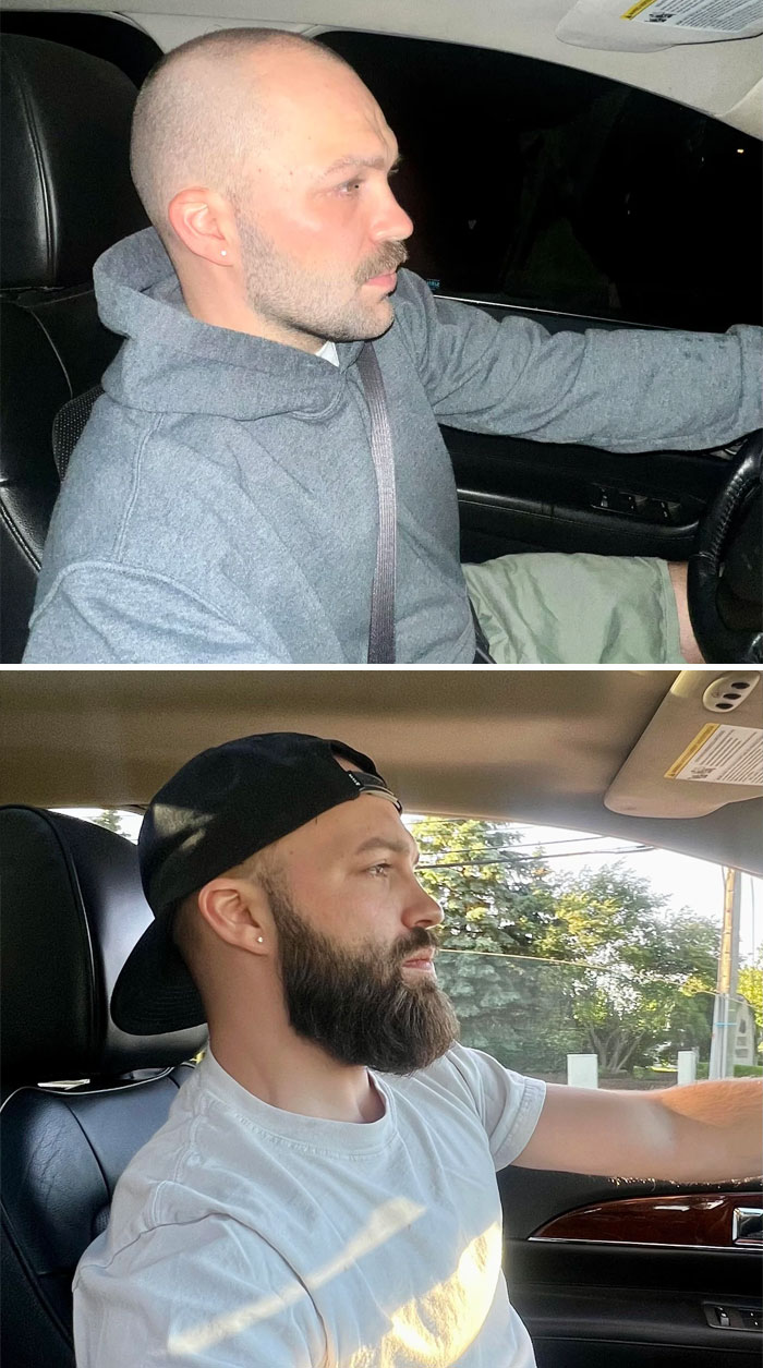 Before And After. Is It Better With No Beard Or With Beard?