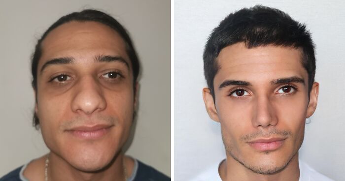 “He Needs A New Identity”: Man Looks Unrecognizable After Going To Turkish Plastic Surgery Clinic