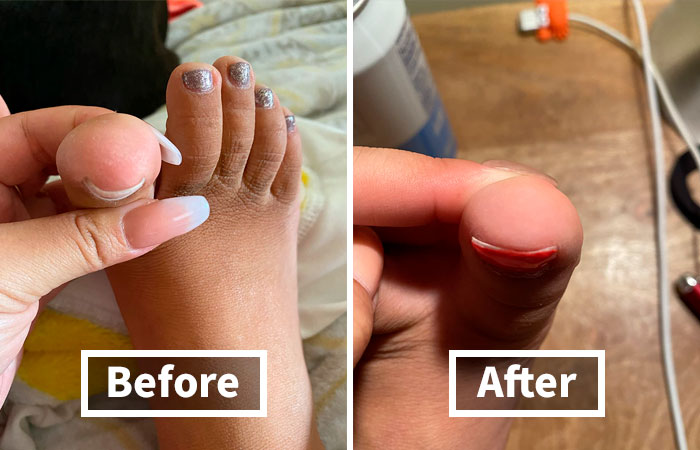 Before and after image of a painted toenail transformation, showcasing a dramatic improvement.
