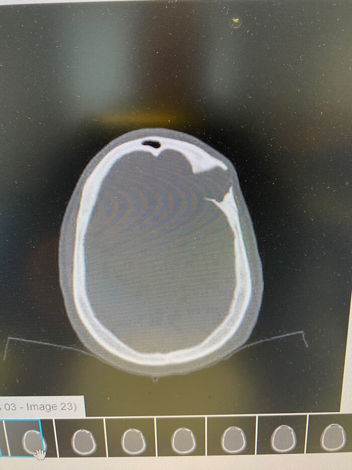 30 Times People Didn’t Think Their Symptoms Were A Big Deal, But They Were