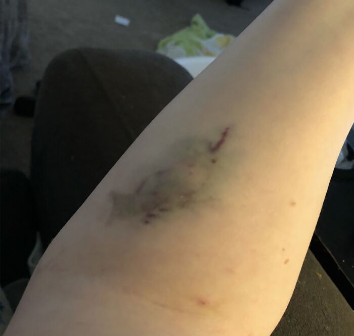 30 Times People Didn’t Think Their Symptoms Were A Big Deal, But They Were