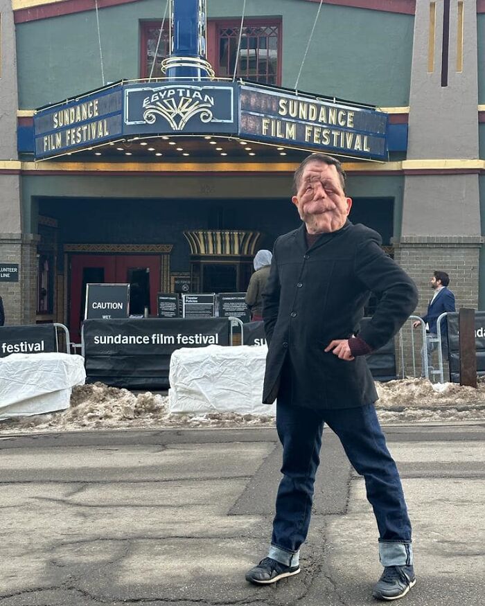 &ldquo;My Disability Has Opened Doors&rdquo;: Actor Adam Pearson Wants To Normalize Facial Disfigurement