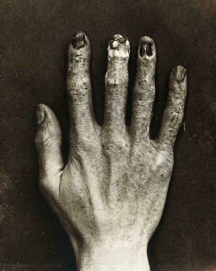 A hand with severely damaged and missing fingernails, a truly creepy image for viewing at your own risk.