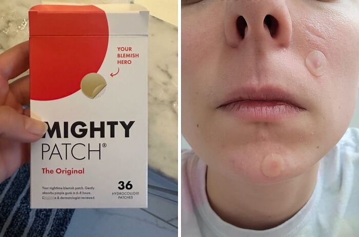 Hydrocolloid Pimple Patches: Fast-Acting Spots Treatment For Smooth, Blemish-Free Skin