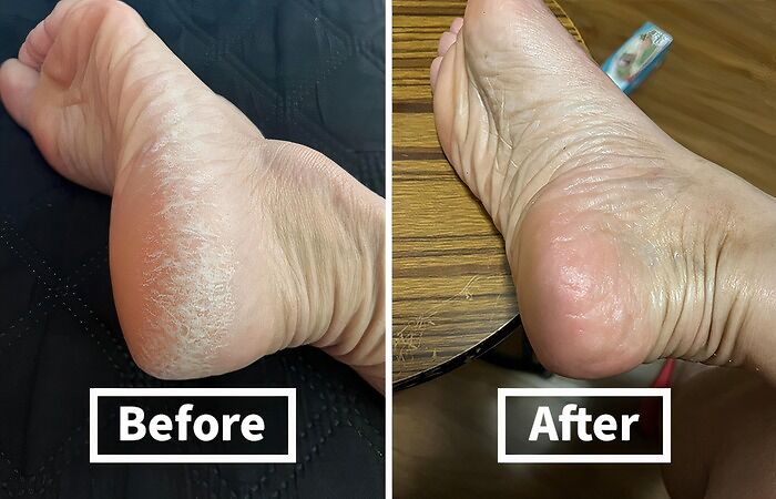Before and after images of dry c*****d heels healed by items that fix everyday annoyances in the coolest way