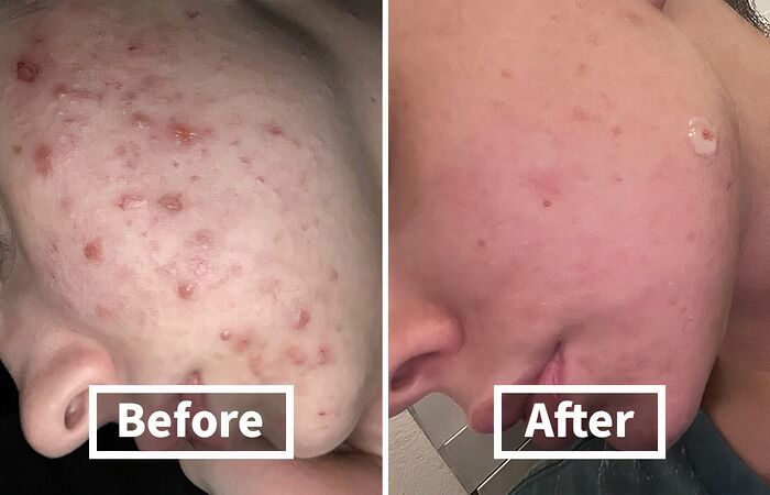 Close-up before and after images showing clear skin improvement using items that fix everyday annoyances effectively.