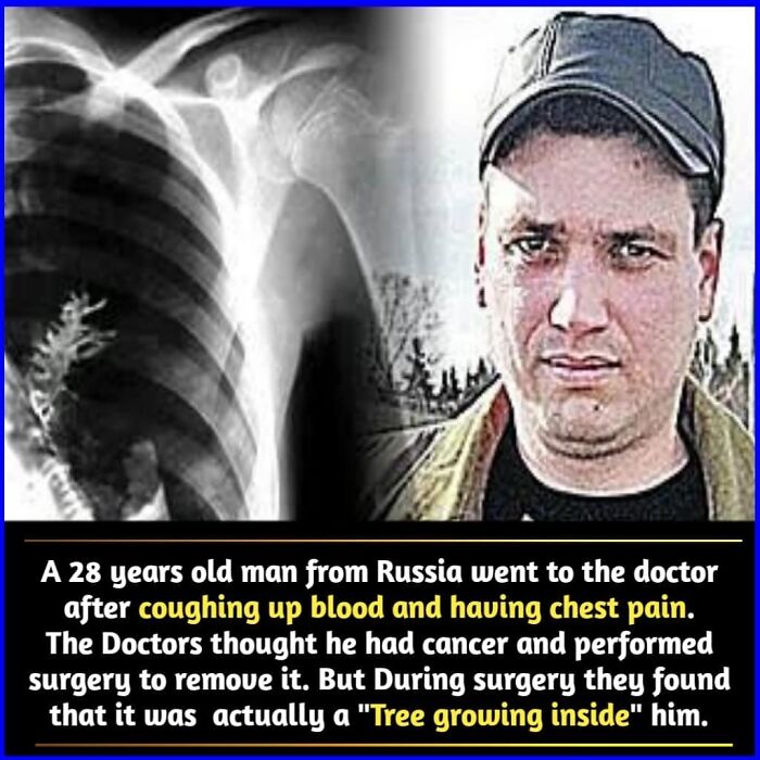 X-ray and photo showing a unique medical case featuring a tree growing inside a man's chest, an amazing fact revealed by doctors.