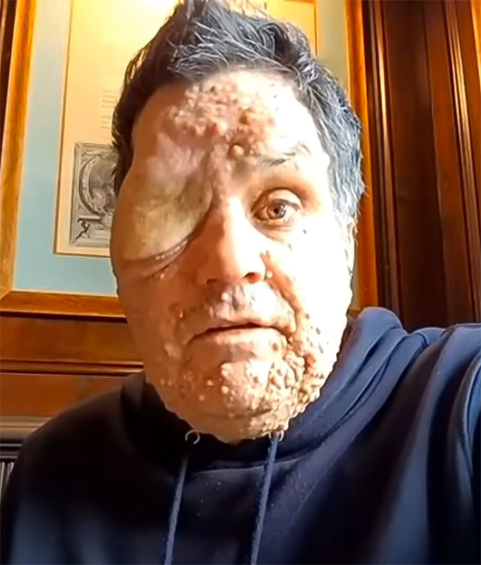 "Scaring The Customers": Man Says Restaurant Threw Him Out Because Of His Facial Disfigurement "Scaring The Customers": Man Says Restaurant Threw Him Out Because Of His Facial Disfigurement