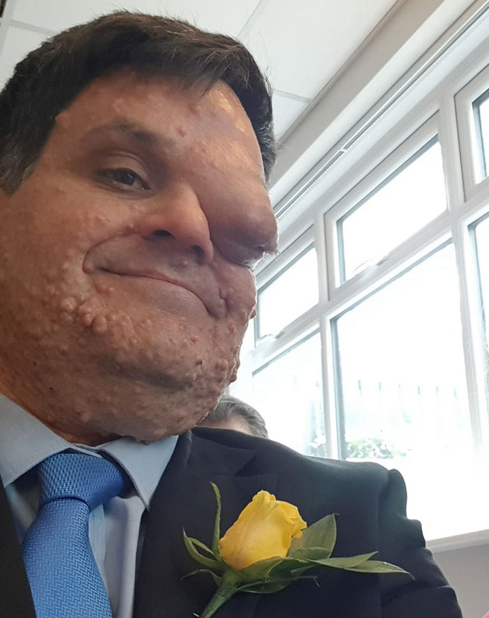 "Scaring The Customers": Man Says Restaurant Threw Him Out Because Of His Facial Disfigurement "Scaring The Customers": Man Says Restaurant Threw Him Out Because Of His Facial Disfigurement